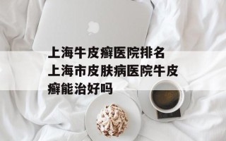 上海牛皮癣医院排名 上海市皮肤病医院牛皮癣能治好吗